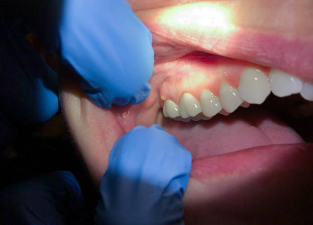 Best Emergency Wisdom Tooth Extraction in Pawhuska, OK
